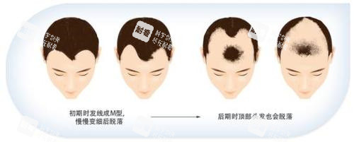 脫發(fā)步驟動(dòng)畫(huà)演示圖