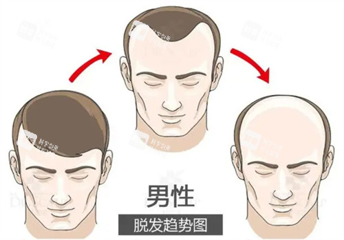 脫發(fā)趨勢(shì)圖