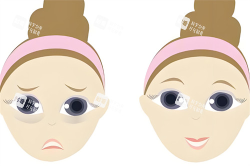 中年祛眼袋前后對(duì)比