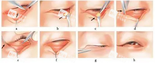 去眼袋手術方法