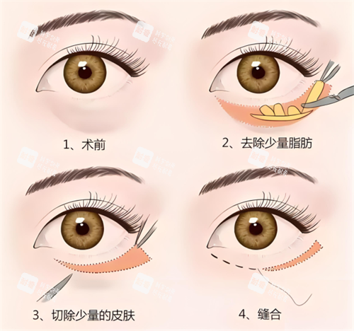 外切祛眼袋術原理