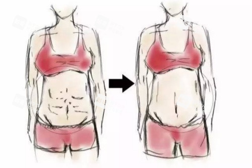 腹壁成型術(shù)卡通對(duì)比圖 腹壁成型術(shù)卡通對(duì)比圖