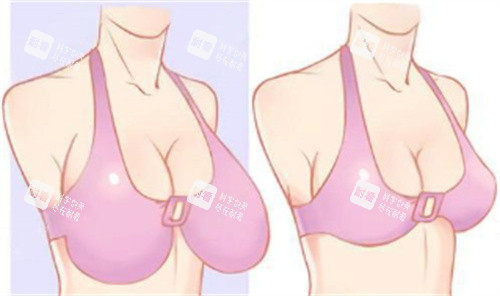 巨乳縮小術(shù) 巨乳縮小術(shù)