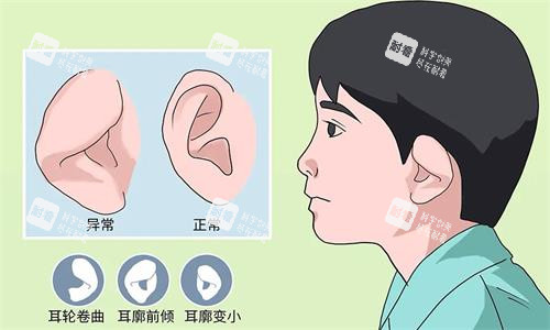 耳朵整形示意圖 耳朵整形示意圖