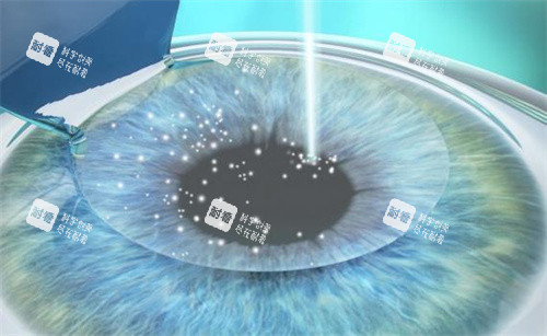 全飛秒手術(shù)原理