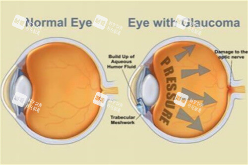 青光眼示意圖