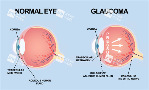 青光眼動畫演示圖