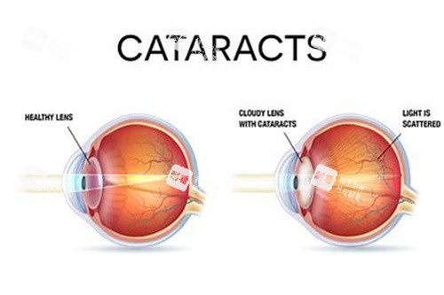 健康眼與白內(nèi)障眼對比