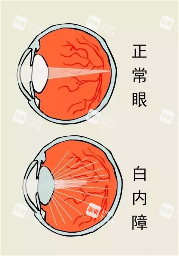 正常眼睛和白內(nèi)障眼睛區(qū)別