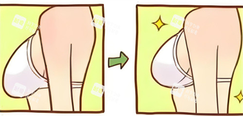 乳房下垂內(nèi)衣穿著對比