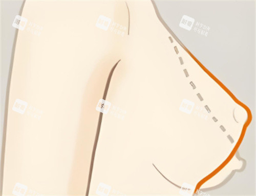 乳房下垂矯正輪廓對比