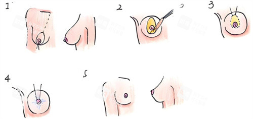 乳房下垂矯正術(shù)過程