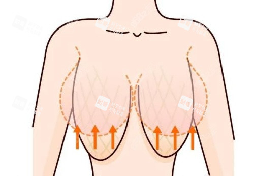 縮胸形態(tài)示意圖 縮胸形態(tài)示意圖