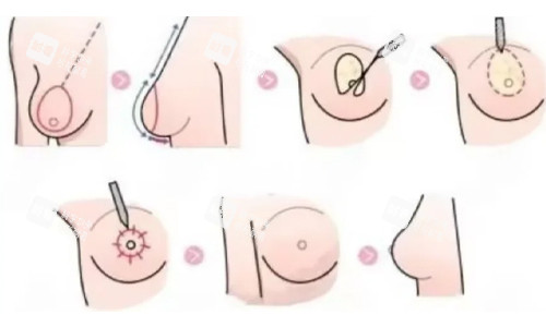 雙環(huán)法縮胸展示 雙環(huán)法縮胸展示