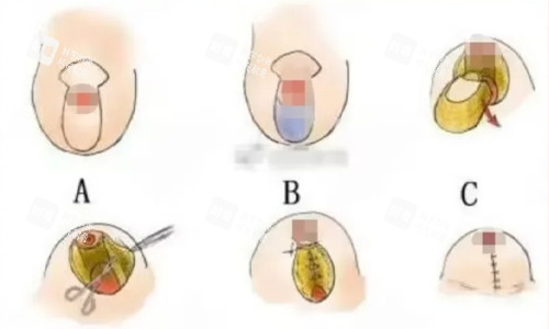 棒棒糖縮胸法(垂直雙蒂法)展示 棒棒糖縮胸法(垂直雙蒂法)展示