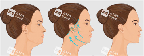 面部提升改善皮膚狀態(tài)