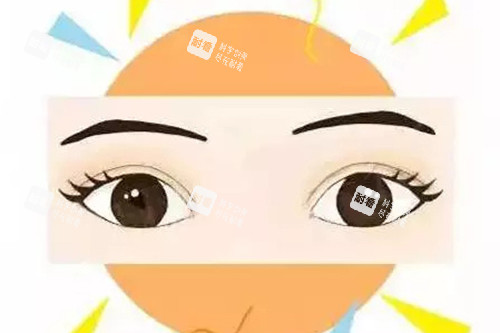 成功雙眼皮示意圖