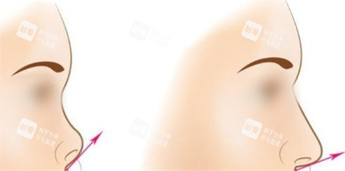 隆鼻手術(shù)鼻尖角度調(diào)整前后對比圖