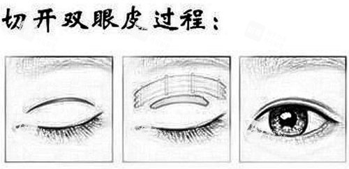 切開(kāi)雙眼皮