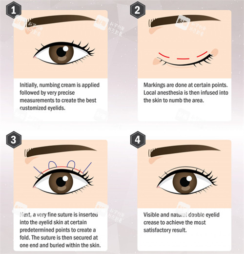 埋線雙眼皮手術(shù)流程圖