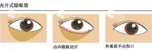 內(nèi)切法祛眼袋手術(shù)過程