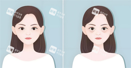 祛眼袋手術(shù)前后對比