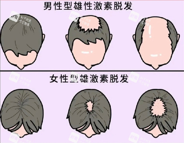 脫發(fā)圖片