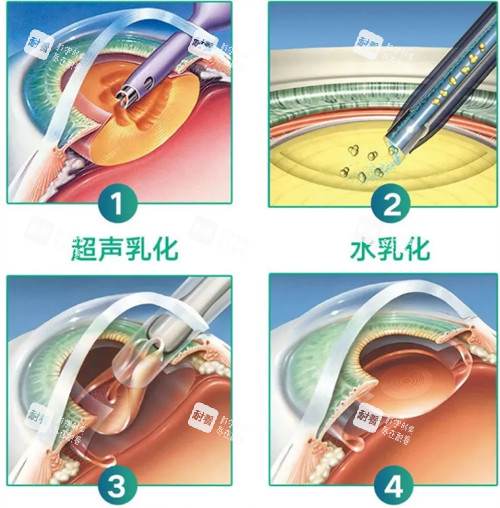 超聲乳化白內(nèi)障手術(shù)過程