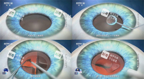 白內(nèi)障手術(shù)流程簡圖