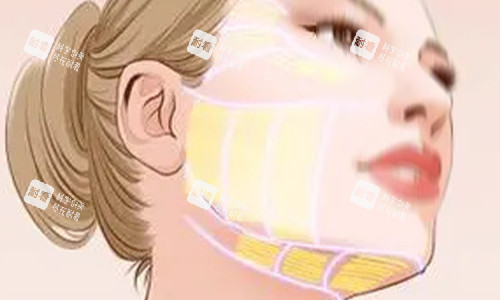 拉皮手術(shù)范圍示意圖