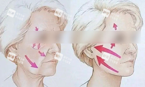 做拉皮手術(shù)前后動畫圖