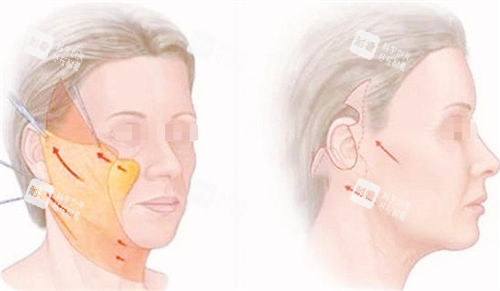 拉皮手術(shù)前后成果對比展示圖