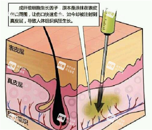 生長因子的副作用解析