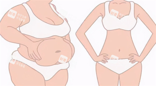 腹部吸脂前后對(duì)比過程 腹部吸脂前后對(duì)比過程