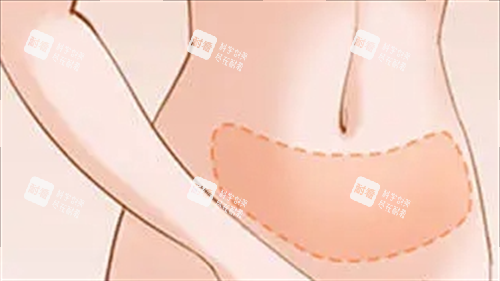 腹部吸脂成效展示圖 腹部吸脂成效展示圖