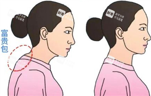 富貴包去除前后對比 富貴包去除前后對比