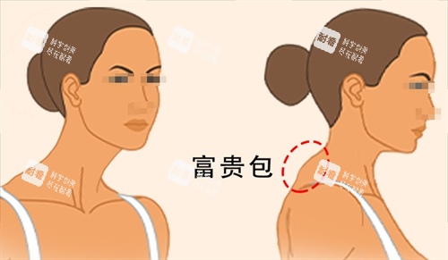 富貴包側(cè)面展示圖 富貴包側(cè)面展示圖