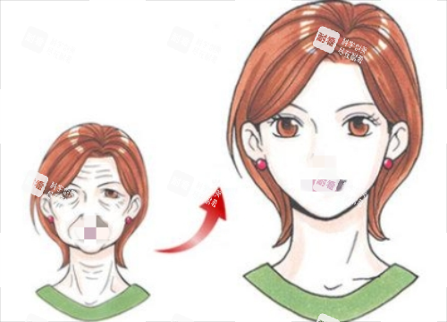 拉皮手術(shù)前后對(duì)比圖