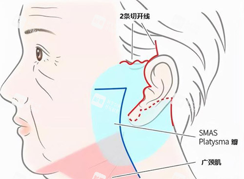 李曉東面部提升手術(shù)水平怎么樣?深耕面部提升領(lǐng)域20余年,專注研究PST和PSV兩種核心技術(shù)