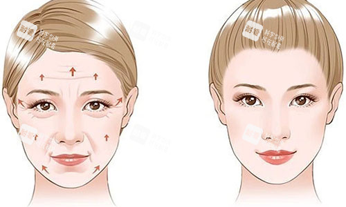 拉皮手術(shù)前后對比圖 拉皮手術(shù)前后對比圖