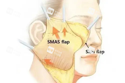 面部拉皮卡通示意圖 面部拉皮卡通示意圖