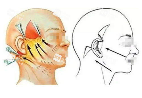 拉皮手術(shù)前后提拉對比圖 拉皮手術(shù)前后提拉對比圖