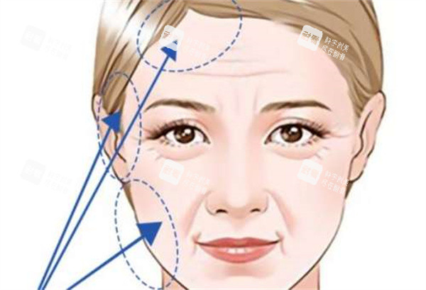 拉皮整形手術(shù) 拉皮整形手術(shù)