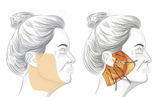 拉皮手術脂肪剝離示意圖