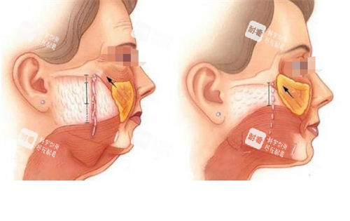 拉皮手術皮下組織切面對比展示圖