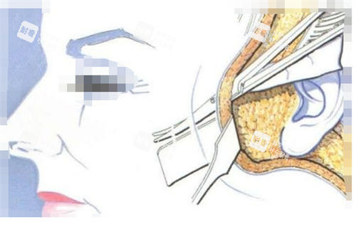 拉皮手術手術剖面圖