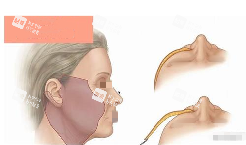 拉皮手術(shù)術(shù)中示意圖