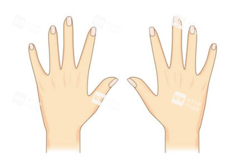 手背拉皮術(shù)后示意圖