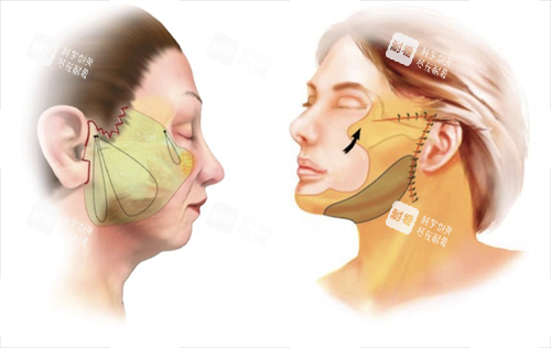 拉皮手術(shù)面部脂肪組織區(qū)域圈畫圖