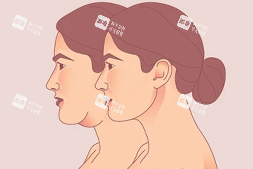 頸部拉皮變成天鵝頸